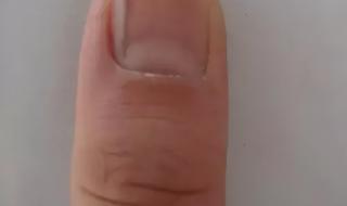 手指甲上有黑色竖纹